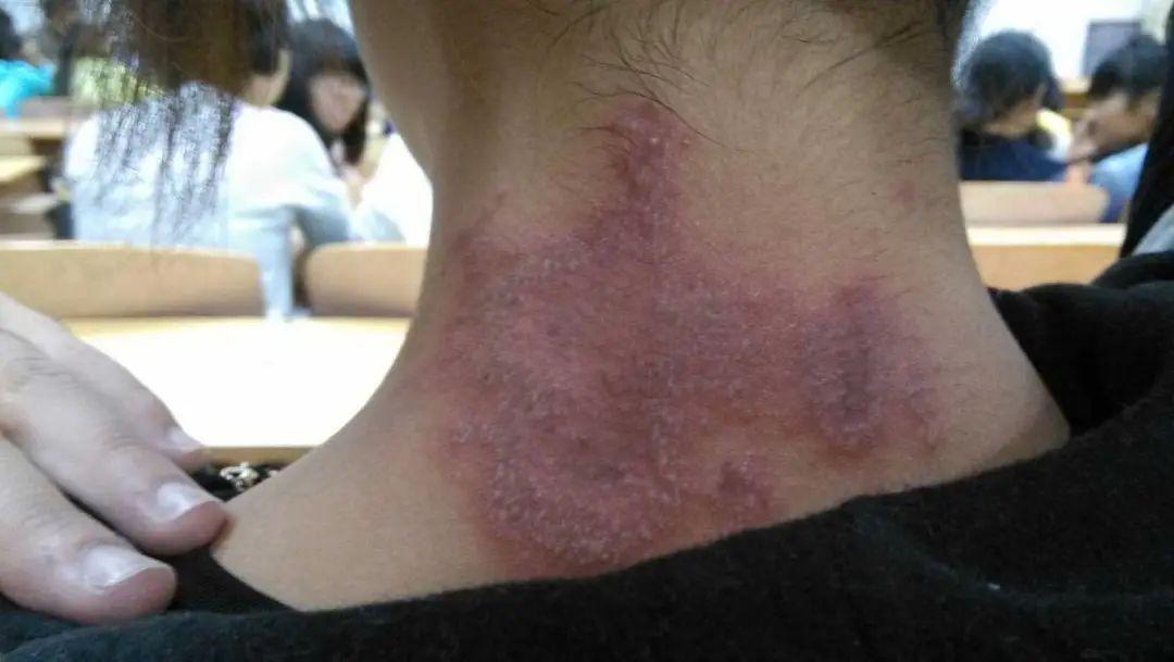 隐翅虫怎样防治(隐翅虫怎么消灭)(图3) 隐翅虫怎样防治(隐翅虫怎么消灭)(图3)