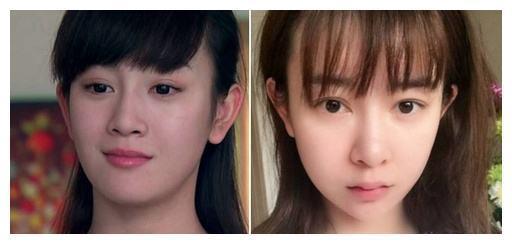 张檬再度整容变毁容，鼻孔朝天双眼皮吓人，脸部僵硬！