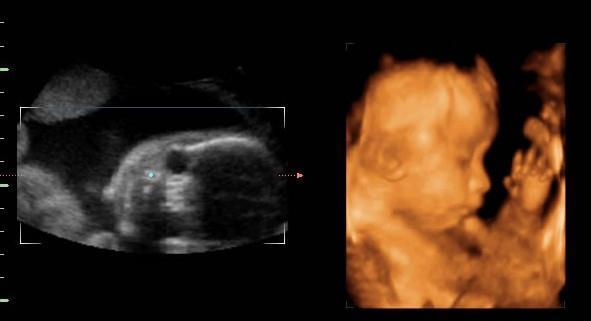 胎儿四维照片丑哭,生出来会不会丑?知道原因后,孕妈可以放心了