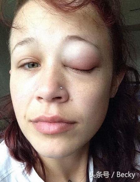 女子尝试在眼球做纹身，结果导致永久性失明，断送了模特生涯