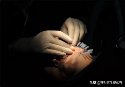 ​不要轻易做“面部线雕”