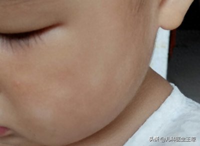 ​孩子脸上的“虫斑”，到底是什么？儿科医生为您详细解析