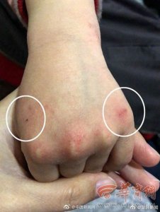 ​西安幼儿园疑现针扎幼儿：3人暂时停职，学生全面体检